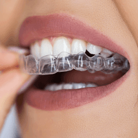 Invisalign Clear Aligners