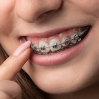 Traditional Metal Braces